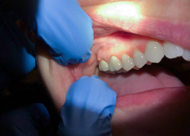 Best Chipped Tooth Repair Near Me  in Puxico, MO